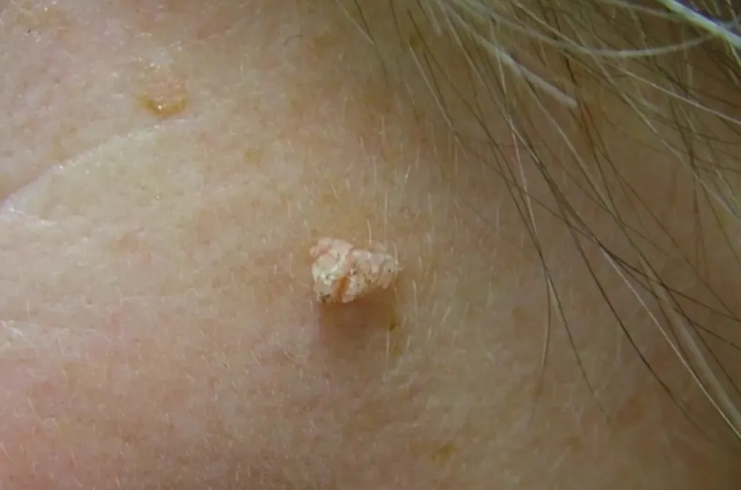 脖子上长出的小肉粒，到底是啥啊？