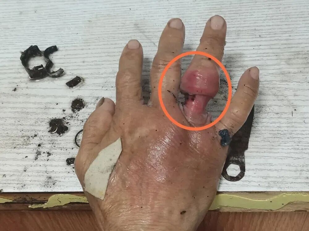 触目惊心!手指肿成“鹌鹑蛋”!元凶很多人都有 触目惊心!手指肿成“鹌鹑蛋”!元凶很多人都有