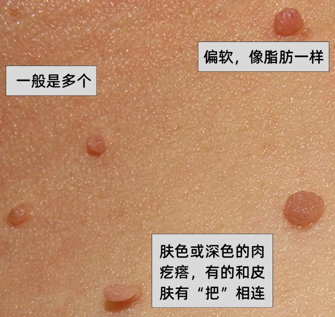 脖子上长出的小肉粒，到底是啥啊？