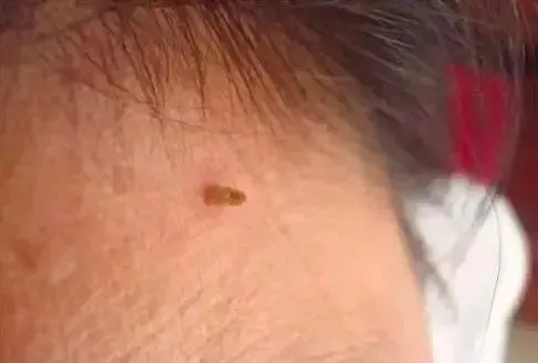 脖子上长出的小肉粒，到底是啥啊？