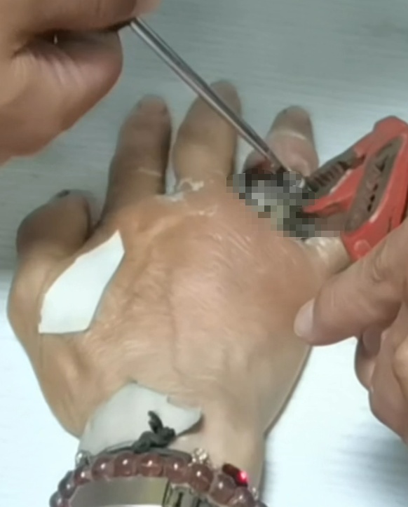 肿成“萝卜手” !多年“老友”让老人手指充血化脓,儿子:根本劝不听... 肿成“萝卜手” !多年“老友”让老人手指充血化脓,儿子:根本劝不听...