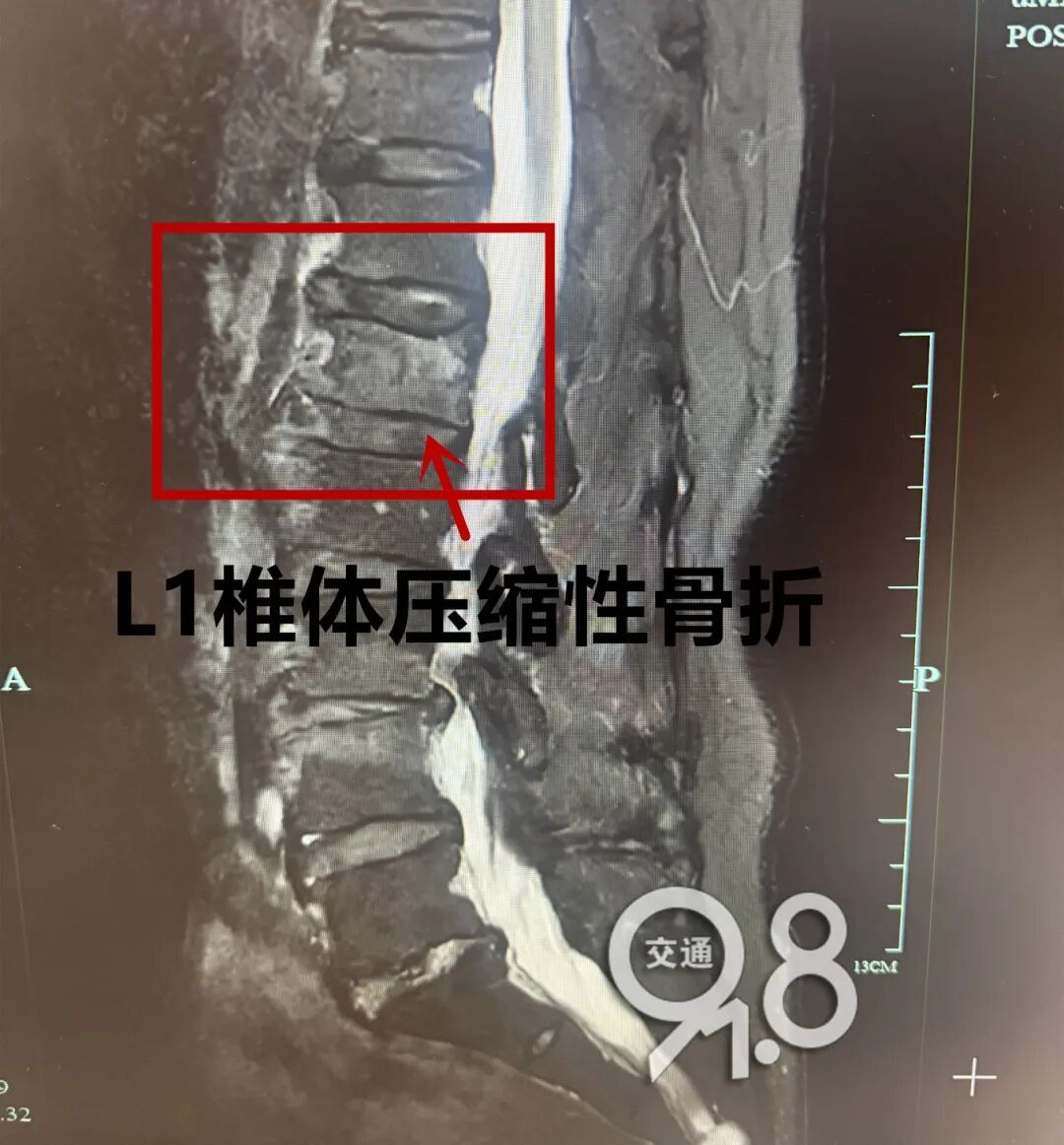 七旬阿姨骑车一摔,腰“碎”了!医生提醒 七旬阿姨骑车一摔,腰“碎”了!医生提醒