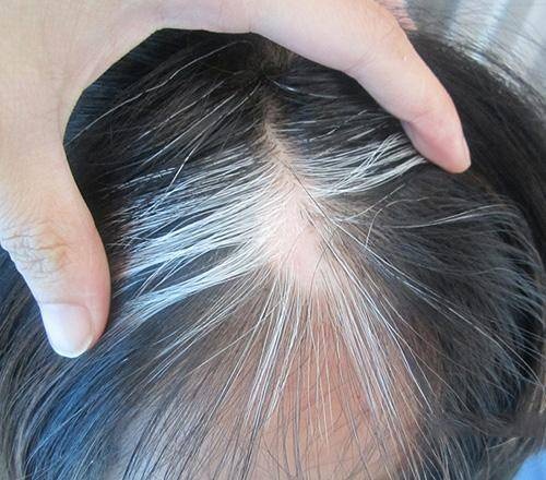 头发白了,还能再黑回去吗? 头发白了,还能再黑回去吗?