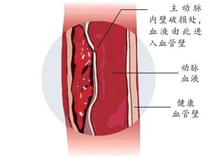 西安一医院1天收治13例!医生:可能几十秒人就没了,有这些征兆务必警惕! 西安一医院1天收治13例!医生:可能几十秒人就没了,有这些征兆务必警惕!