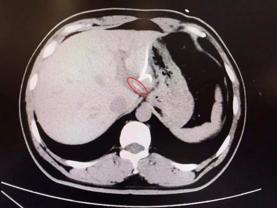 崩溃！因为一根小鱼刺，37岁男子竟要切肝保命？