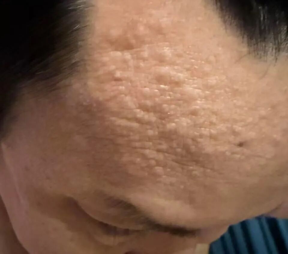 对“寒冷”过敏?是真的!严重可致休克 对“寒冷”过敏?是真的!严重可致休克