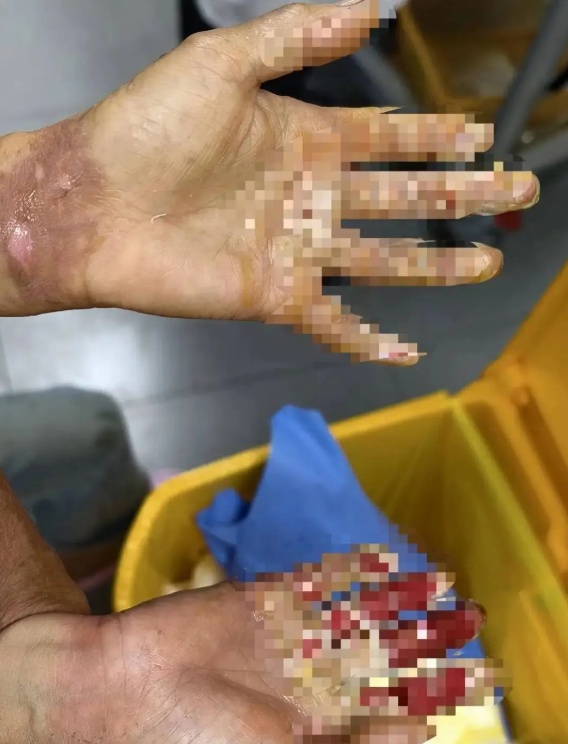 3岁男童不慎跌入炭火堆,全身85%烧伤 3岁男童不慎跌入炭火堆,全身85%烧伤