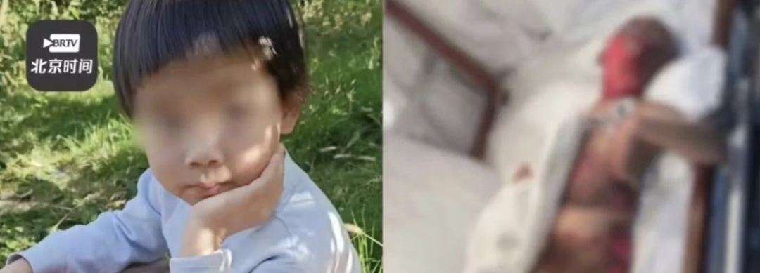 3岁男童不慎跌入炭火堆,全身85%烧伤 3岁男童不慎跌入炭火堆,全身85%烧伤