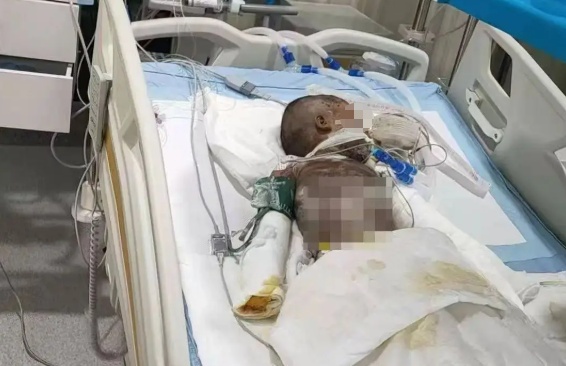 3岁男童不慎跌入炭火堆,全身85%烧伤 3岁男童不慎跌入炭火堆,全身85%烧伤