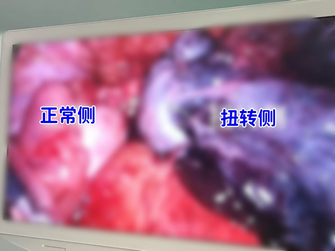 杭州10岁女孩险些被切除卵巢！医生紧急提醒