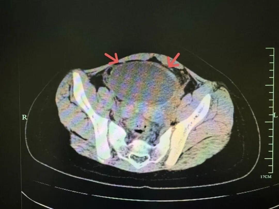 杭州10岁女孩险些被切除卵巢！医生紧急提醒