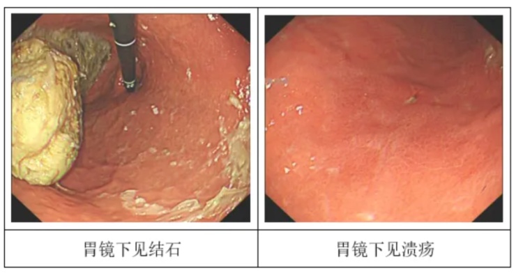 痛到直冒冷汗！连吃20个这种东西，胃里竟长出“鸭蛋”