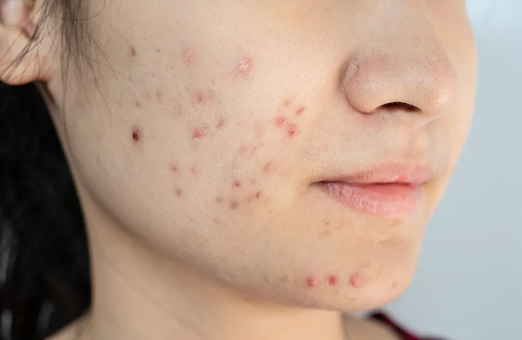 红霉素软膏千万不能随便用！赶紧告诉家里人