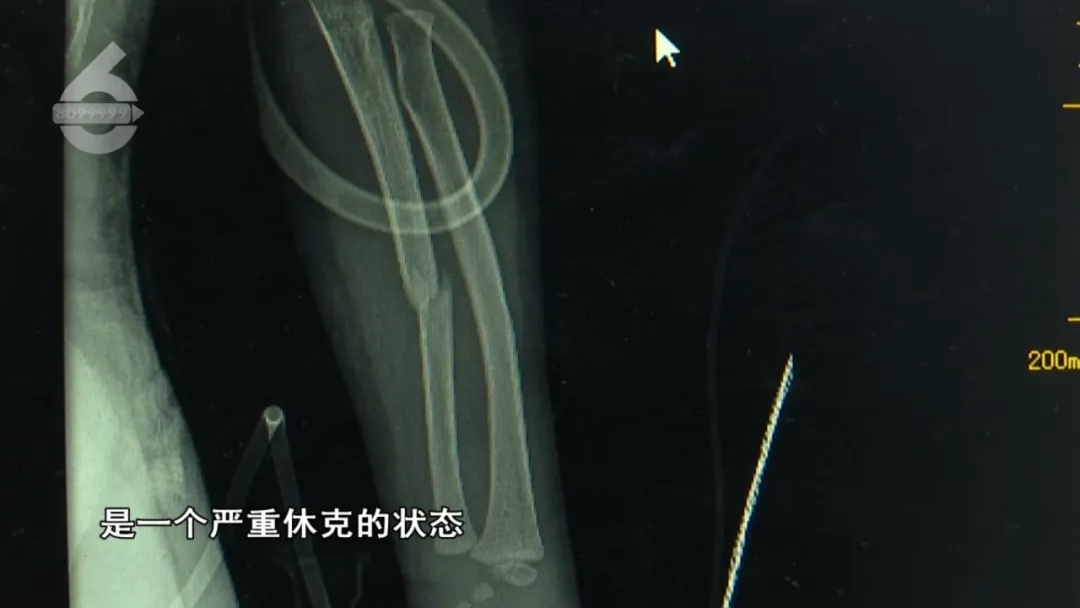 惊险！5岁女童从23楼坠落，奇迹生还！