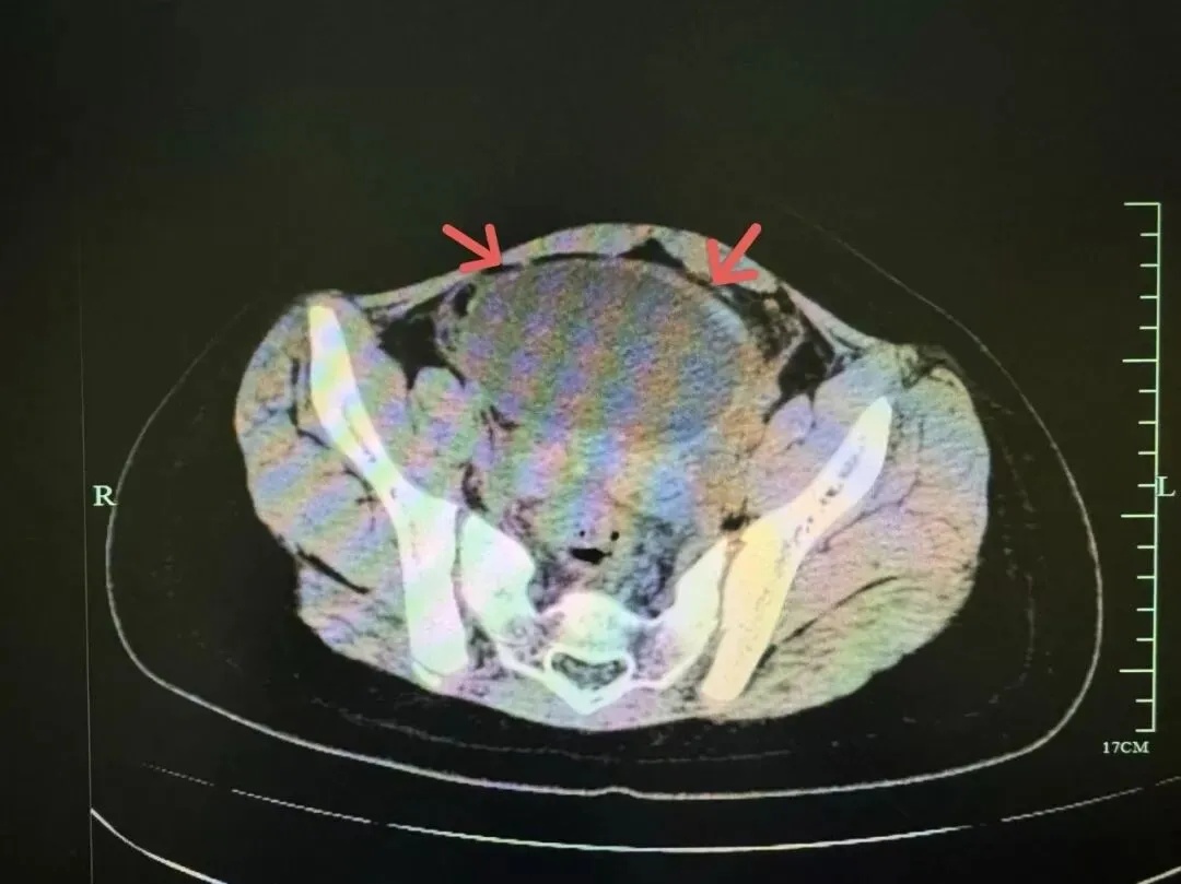 太可怕！浙江10岁女孩差点失去卵巢！极易被误诊