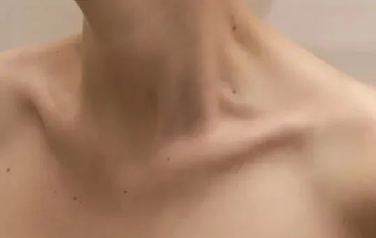 确诊癌症！男子一颗痣长了20年，一直没重视，医生紧急提醒