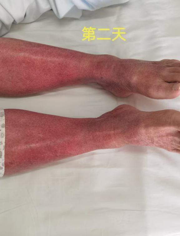 一次普通感冒，81岁老人全身水肿变成“小红人”！医生问诊发现这与他吃的药有关