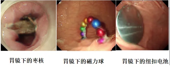 11岁孩子误吞10克重的金豆!妈妈称“天天叮嘱他不要在外面上厕所” 11岁孩子误吞10克重的金豆!妈妈称“天天叮嘱他不要在外面上厕所”