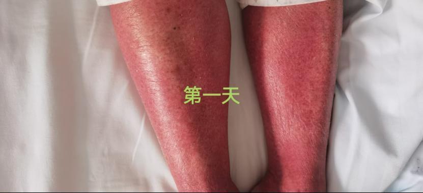 一次普通感冒，81岁老人全身水肿变成“小红人”！医生问诊发现这与他吃的药有关