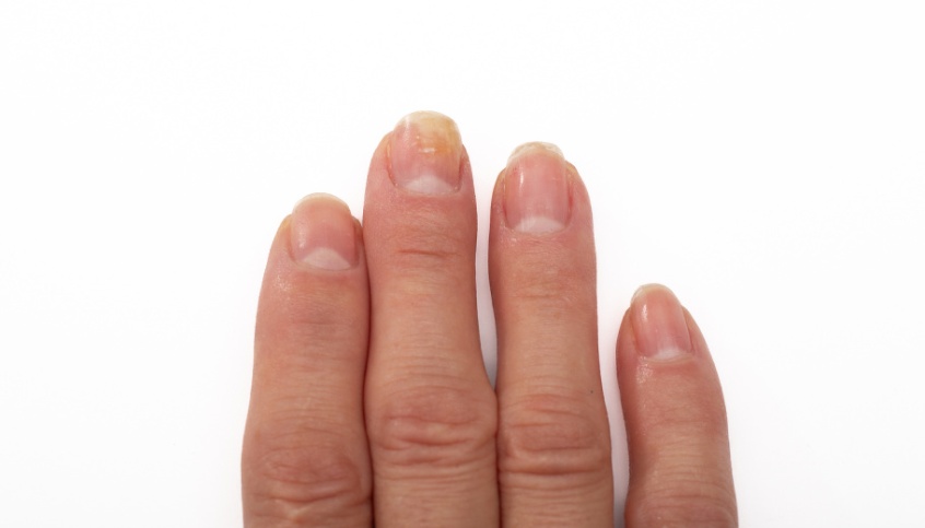 浙江23岁小伙手指痛，一查竟然是皮肤病！医生提醒：最近正高发，极易误诊！