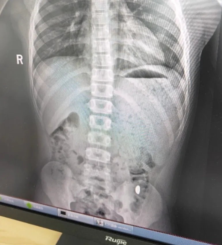 11岁孩子误吞10克重的金豆!妈妈称“天天叮嘱他不要在外面上厕所” 11岁孩子误吞10克重的金豆!妈妈称“天天叮嘱他不要在外面上厕所”