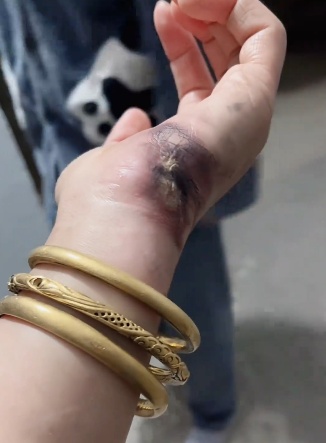 一瞬间手部被“烧熟”，手镯被电碎，只因忽视这个细节