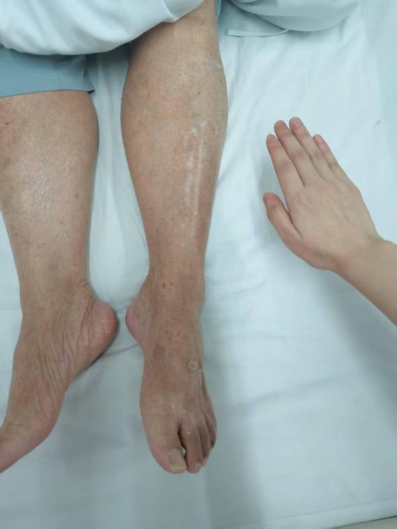 一次普通感冒，81岁老人全身水肿变成“小红人”！医生问诊发现这与他吃的药有关