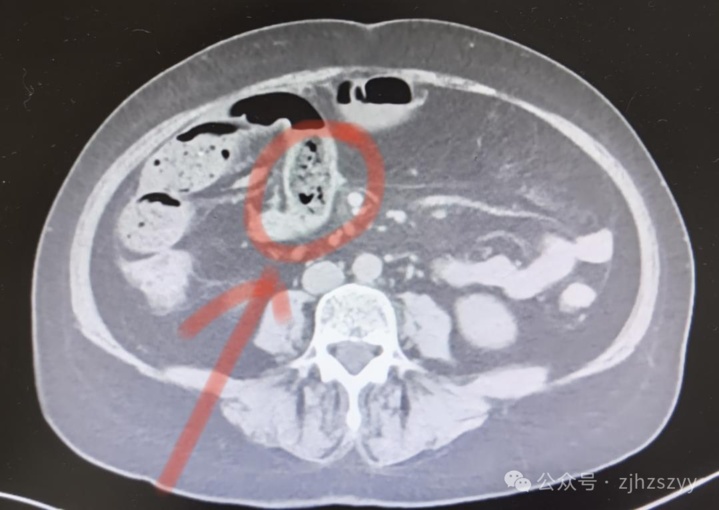 一连“炫”好几个致肠梗阻 这四类食物勿与它同食