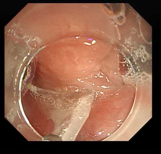 浙江阿姨深夜紧急送医，只因吃了一口……医生：这种做法大错特错