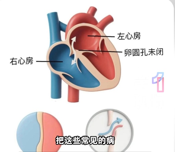 深圳一女子头疼20年，竟是因为心脏…