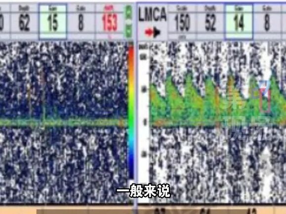 深圳一女子头疼20年，竟是因为心脏…