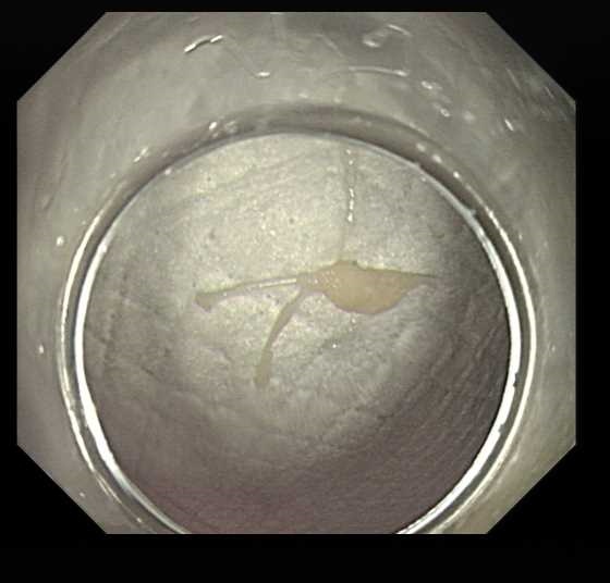 浙江阿姨深夜紧急送医，只因吃了一口……医生：这种做法大错特错