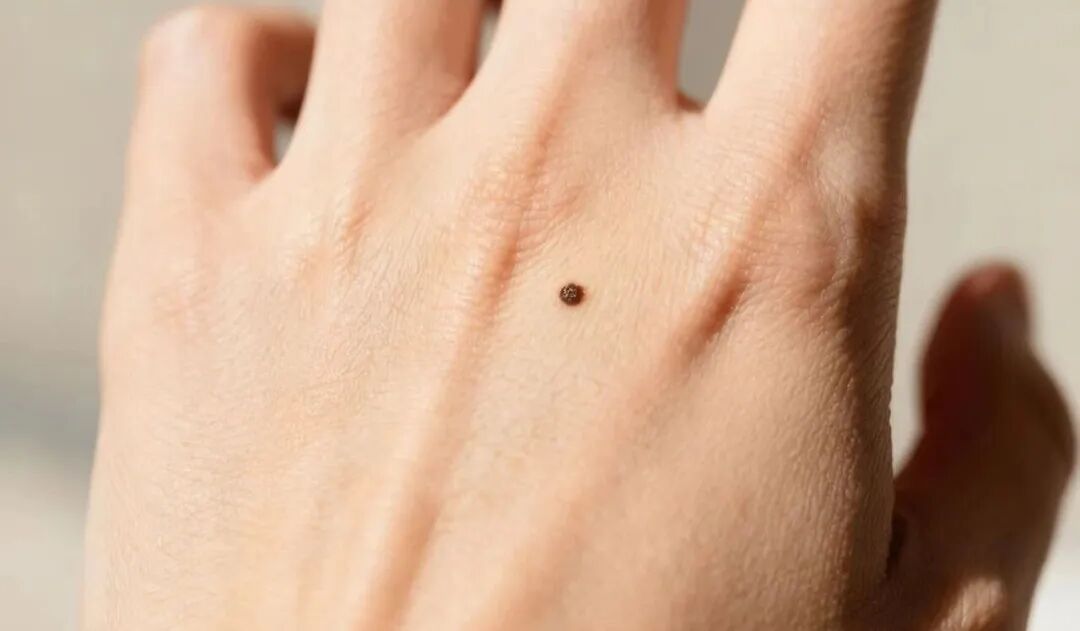 长了20年的痣确诊癌症？赶紧自查！这4个部位的痣最容易恶变！