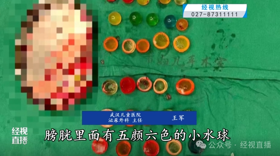 武汉14岁少年膀胱里发现38颗“水宝宝”！医生开腹切膀胱耗时2小时取出