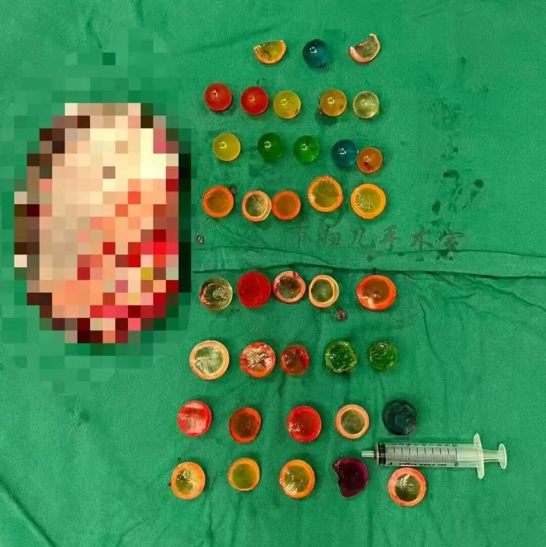 膀胱要"炸"了！14岁少年做B超震惊医生！整整38颗…重要提醒→