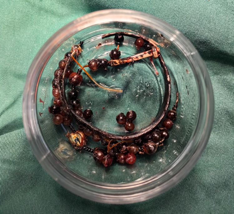 33岁女子戴手镯10年不摘,长胖后嵌进肉里,导致严重感染 33岁女子戴手镯10年不摘,长胖后嵌进肉里,导致严重感染