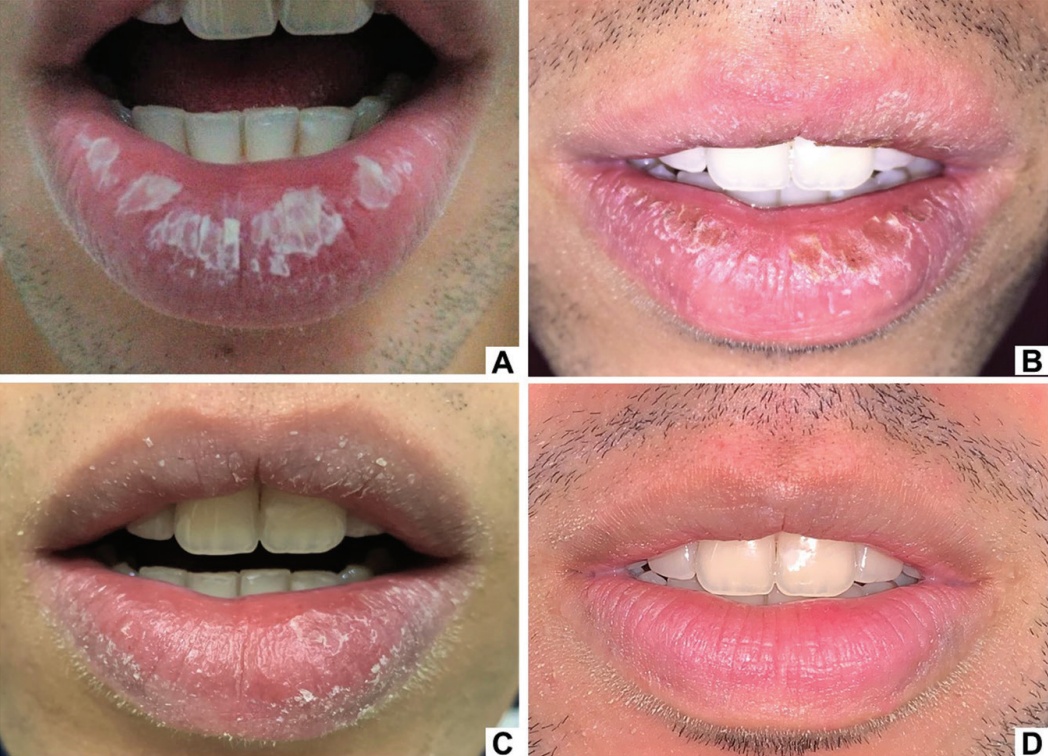 嘴唇总是干裂起皮，可能是病了！