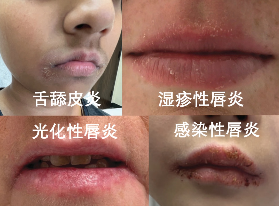 嘴唇总是干裂起皮，可能是病了！