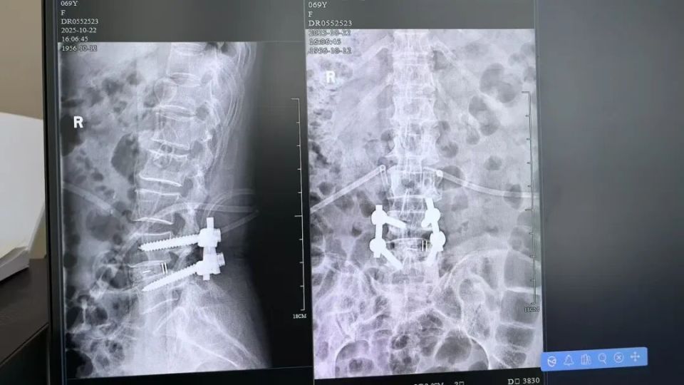 离奇！杭州女子出门穿了个鞋，突然下肢瘫痪，大小便失禁！竟是腰椎掉出两块