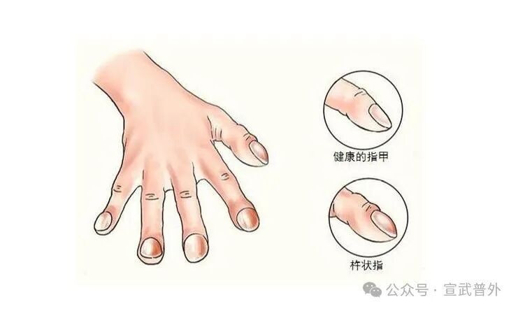 手指肿胀是身体发出的 “奇怪信号”! 手指肿胀是身体发出的 “奇怪信号”!