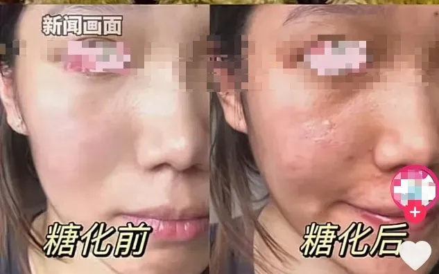 吃奶皮子糖葫芦吃成“糖化脸”?医生提醒→ 吃奶皮子糖葫芦吃成“糖化脸”?医生提醒→