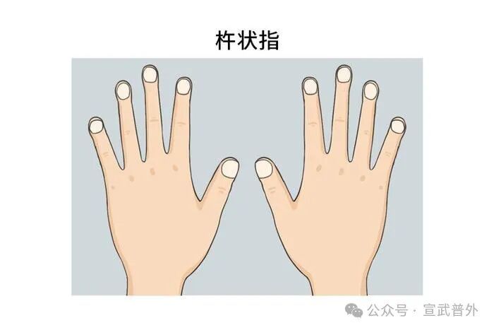 手指肿胀是身体发出的 “奇怪信号”! 手指肿胀是身体发出的 “奇怪信号”!