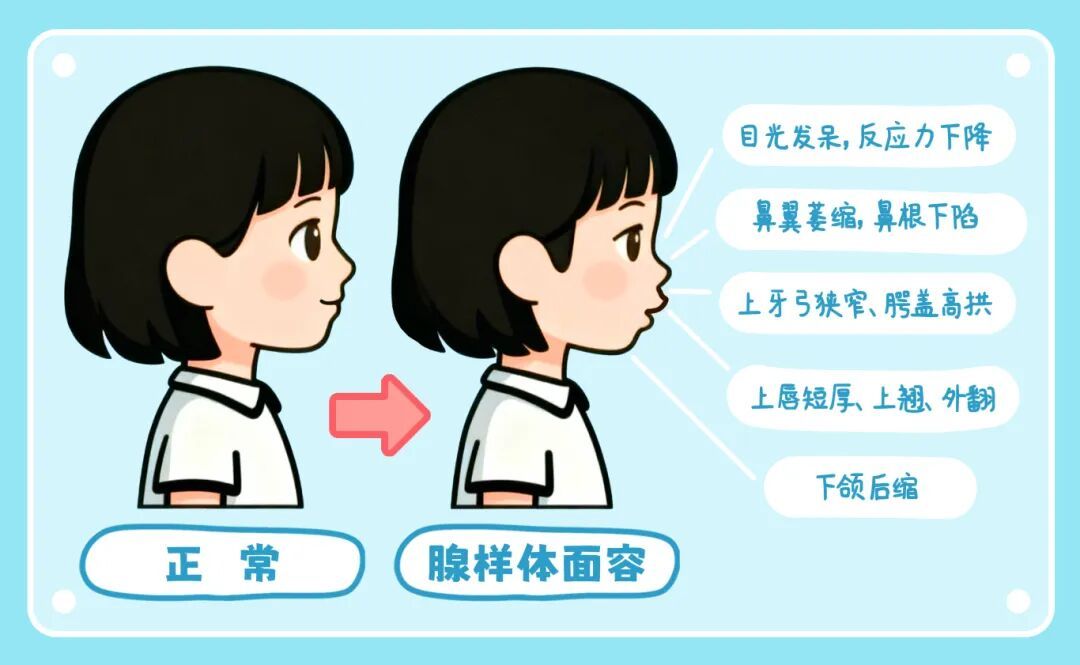 口呼吸，会悄悄地偷走你的颜值吗？