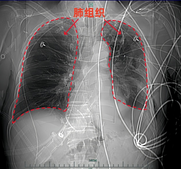 40岁男子体检竟发现肺少一半！医生紧急提醒