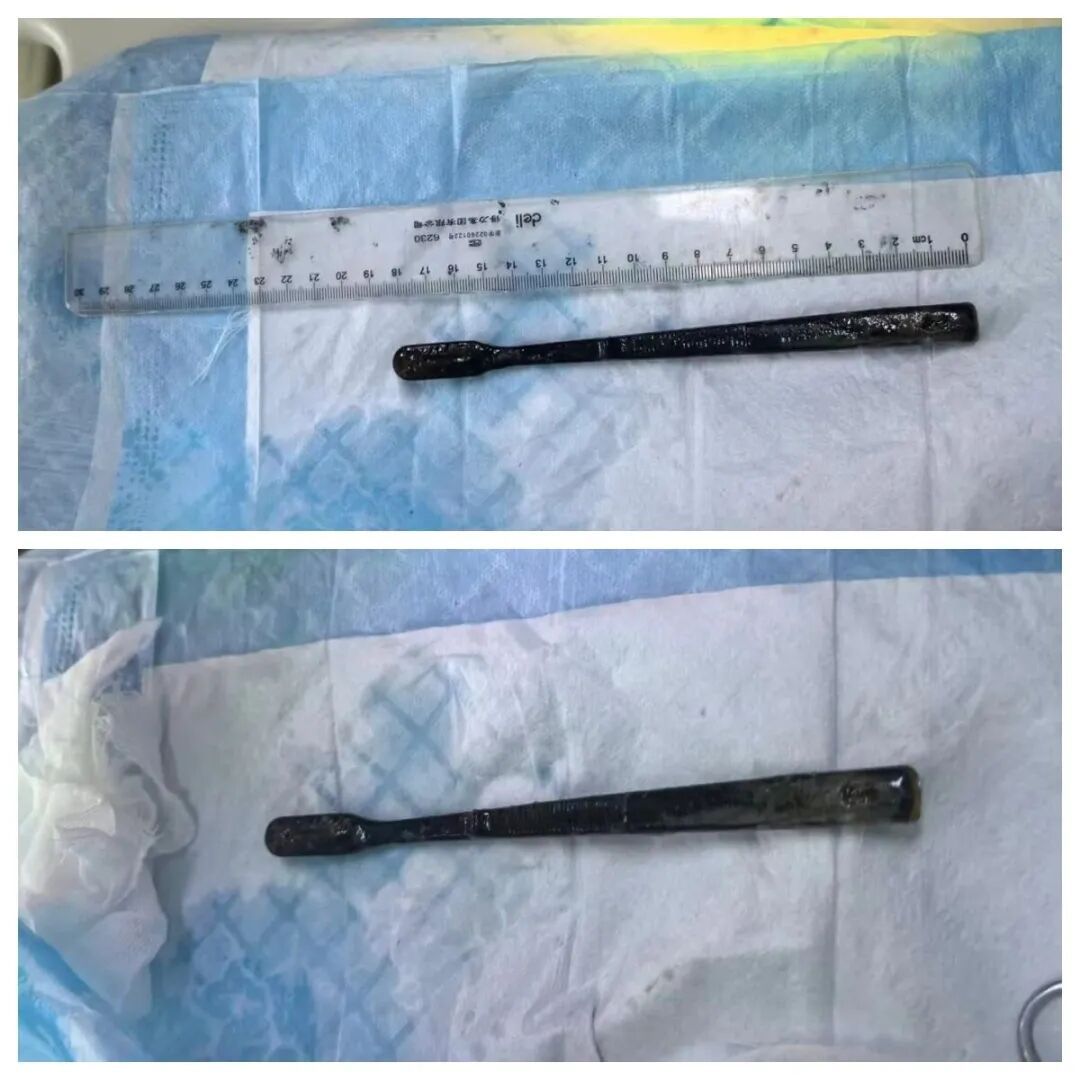 震惊!男子胃里找到牙刷,放了27年,还是两把…… 震惊!男子胃里找到牙刷,放了27年,还是两把……