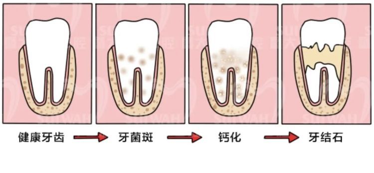 每天都刷牙，为啥还是会口臭？都是这个小东西在作祟