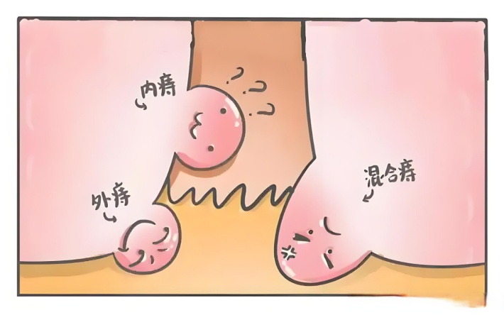 拒绝成为有“痔”青年