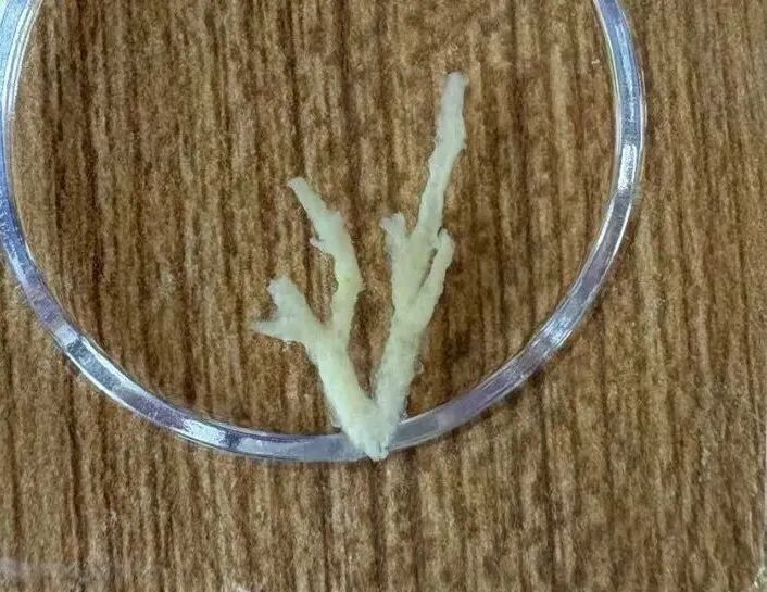 发热仅1天，肺全白了！这种情况极度危险，千万别当普通感冒