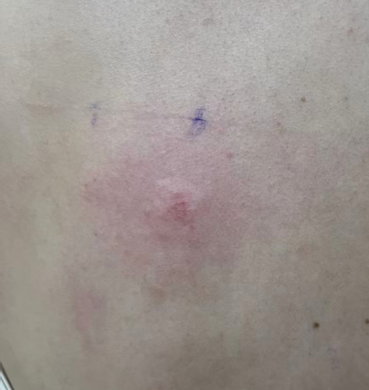 发红发痒，耳朵肿成“招风耳”！医院一查懵了，“元凶”竟是这种常见的小东西