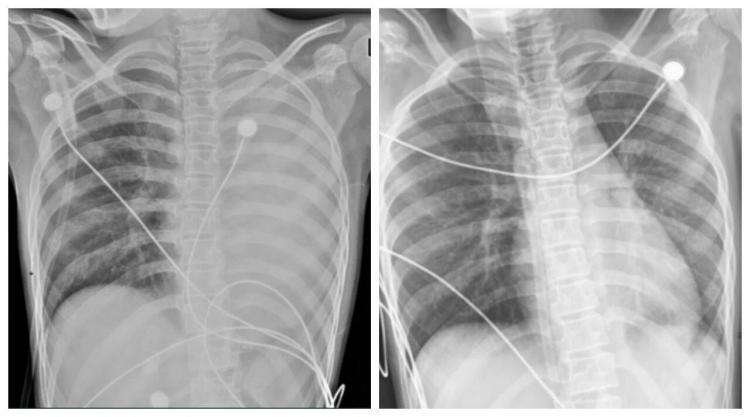 发热1天左肺全白！这种病可堵塞气道，别误当普通感冒